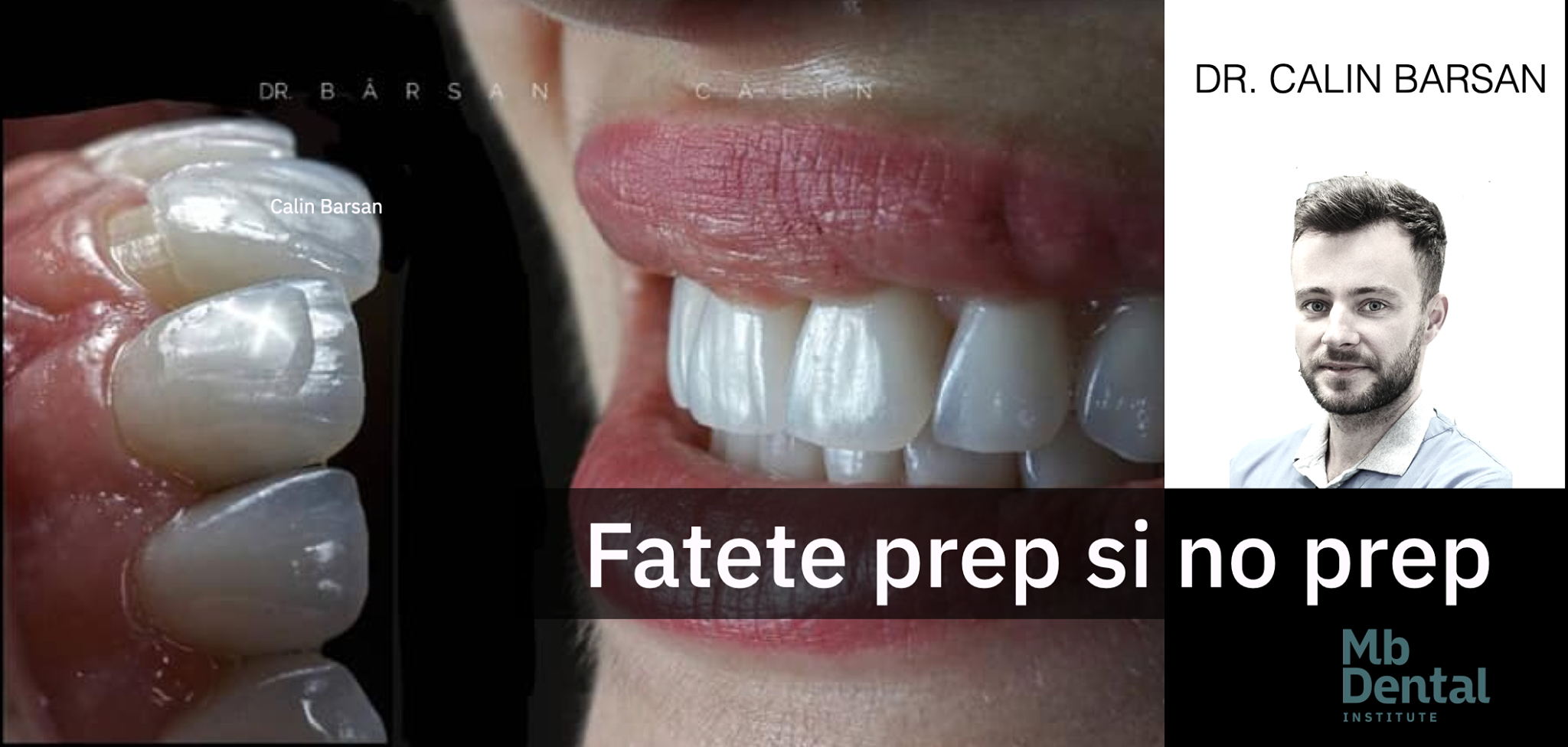 Fațete ceramice prep & no prep. Prepari, amprentezi, cimentezi. (noiembrie 2020)