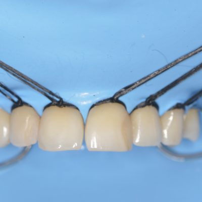 Izolarea cu diga pentru incepatori (in tratamente endo, resto, protetica) -  Invata rapid si aplica eficient (noiembrie 2020)