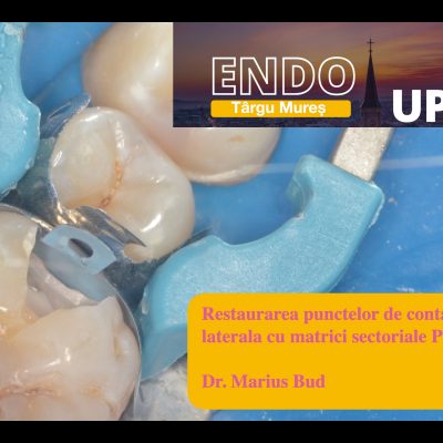 Restaurarea corecta a punctelor de contact in zona laterala cu matrici sectoriale Palodent Plus (octombrie 2022)